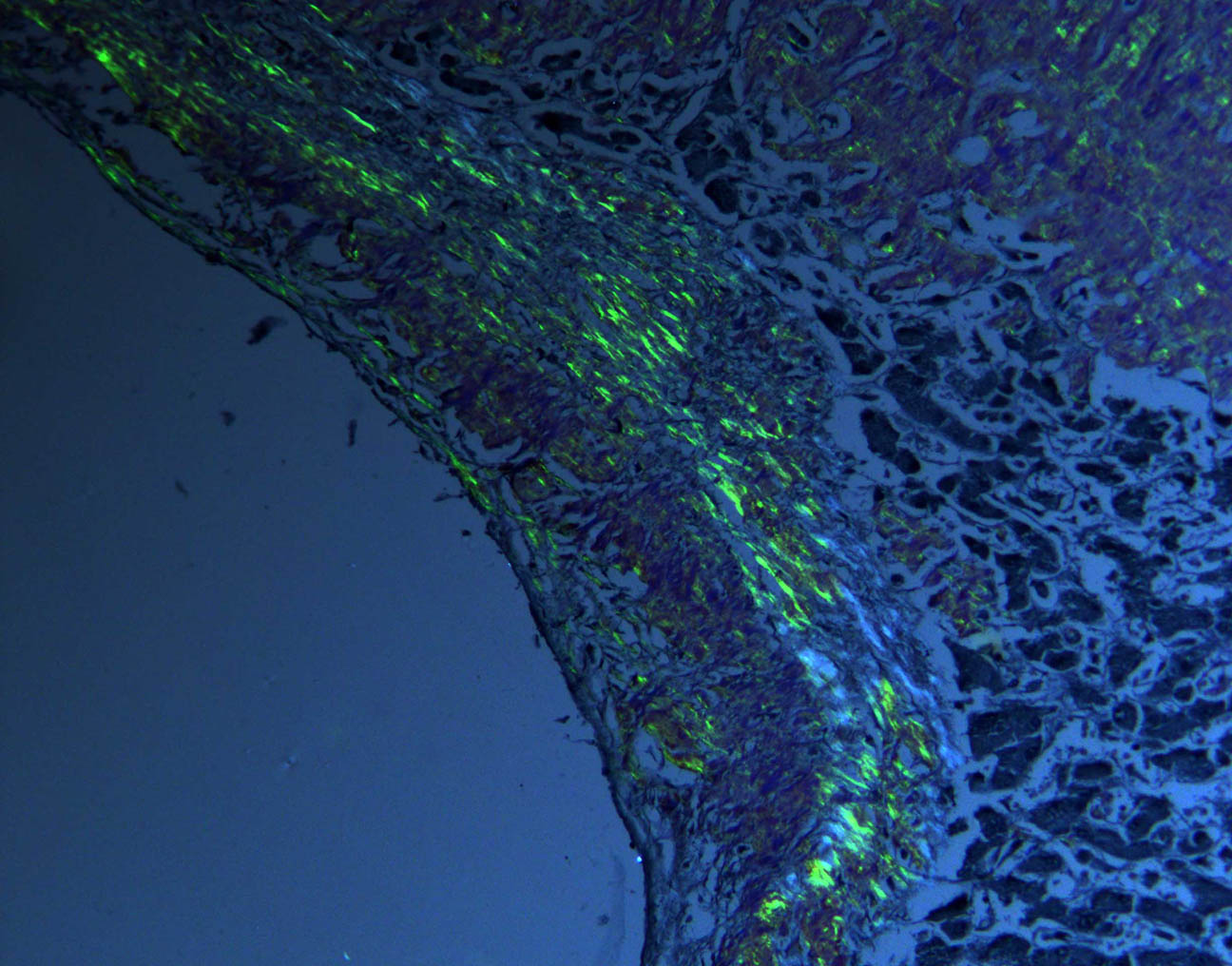 显微镜下显示的存在淀粉样变性的人体组织