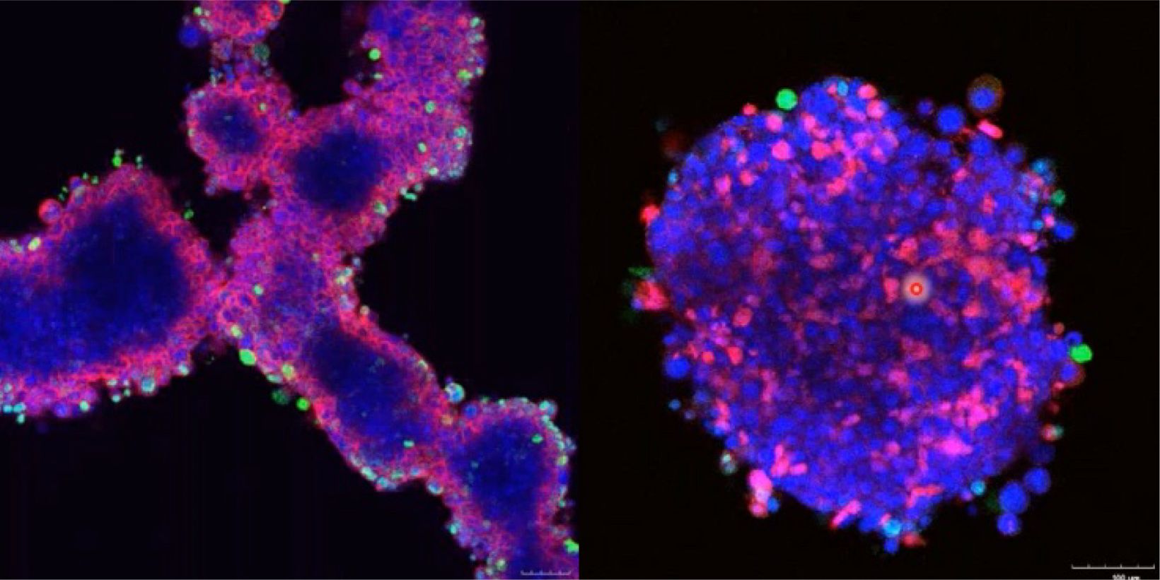 An In Vitro System for Evaluating Anticancer Drugs Using Patient-Derived Tumor Organoids