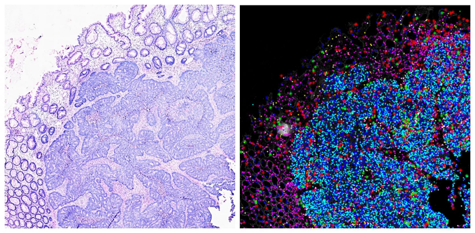 Investigating Tumor Dissemination by Spatial Transcriptomics