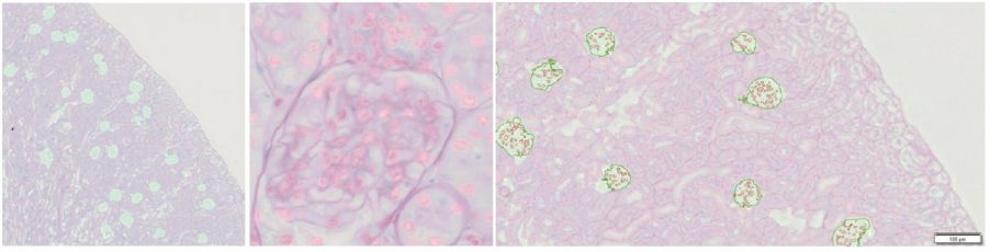 显示TruAI标记和计数肾小球和肾细胞核的三张载玻片样品图像