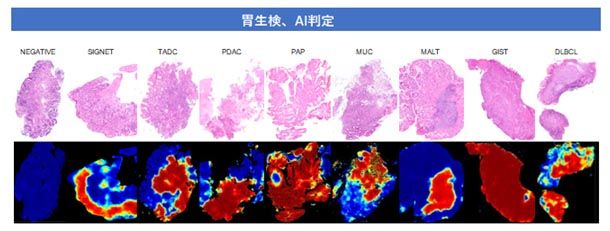 本AIによる胃生検の判定イメージ。上段:デジタル病理画像、下段:AI判定。陽性は赤、陰性は青で表示される。